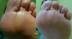 Hiperqueratosis Metatarsal