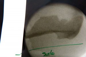 Radiografía Espolón